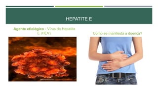 HEPATITE E
Agente etiológico - Vírus da Hepatite
E (HEV).

Como se manifesta a doença?

 