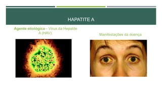 HAPATITE A
Agente etiológico - Vírus da Hepatite
A (HAV).

Manifestações da doença

 