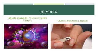 HEPATITE C
Agente etiológico - Vírus da Hepatite
C (HBV).

Como se manifesta a doença?

 