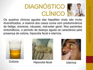 DIAGNÓSTICO
CLÍNICO
Os quadros clínicos agudos das hepatites virais são muito
diversificados, a maioria dos casos cursa com predominância
de fadiga, anorexia, náuseas, mal-estar geral. Nos pacientes
sintomáticos, o período de doença aguda se caracteriza pela
presença de colúria, hipocolia fecal e icterícia.
Coliúria Hipocolia fecal
DIAGNOSTICANDOASHEPATITES
Icterícia
DIAGNOSTICANDOASHEPATITES
 