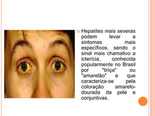  Hepatites mais severas
podem levar a
sintomas mais
específicos, sendo o
sinal mais chamativo a
icterícia, conhecida
popularmente no Brasil
por "tiriça" ou
"amarelão" e que
caracteriza-se pela
coloração amarelo-
dourada da pele e
conjuntivas.
 