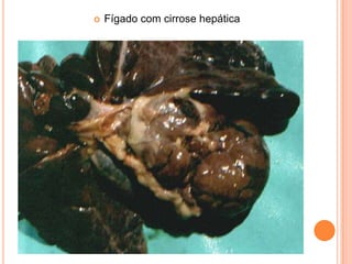 Fígado com cirrose hepática
 