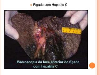  Fígado com Hepatite C
 