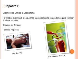 oHepatite B

Diagnóstico Clínico e Laboratorial

* O médico examinará a pele, olhos e principalmente seu abdômen para verificar
sinais de hepatite;

*Exames de Sangue;

* Biópsia Hepática;
 