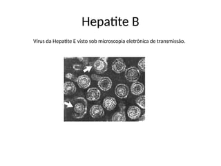 Hepatite B
Vírus da Hepatite E visto sob microscopia eletrônica de transmissão.
 