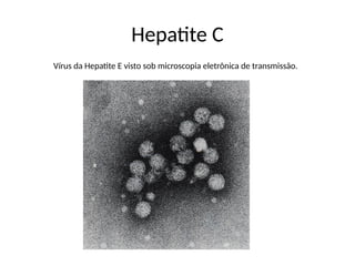 Hepatite C
Vírus da Hepatite E visto sob microscopia eletrônica de transmissão.
 