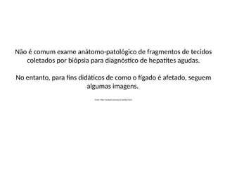 Não é comum exame anátomo-patológico de fragmentos de tecidos
coletados por biópsia para diagnóstico de hepatites agudas.
No entanto, para fins didáticos de como o fígado é afetado, seguem
algumas imagens.
Fonte: http://anatpat.unicamp.br/lamfig1.html.
 