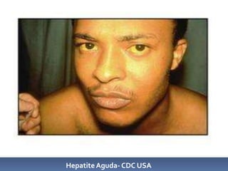 Hepatite Aguda- CDC USA
 