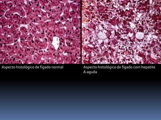Aspecto histológico de fígado normal   Aspecto histológico de fígado com hepatite
                                       A aguda
 