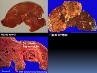 Fígado normal                   Fígado cirrótico


                Carcinoma
                Hepatocelular
 