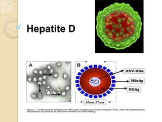 Hepatite D
 