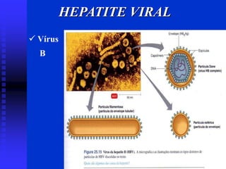 HEPATITE VIRAL
 Vírus
B
 