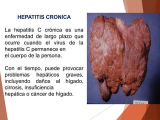HEPATITIS CRONICA
La hepatitis C crónica es una
enfermedad de largo plazo que
ocurre cuando el virus de la
hepatitis C permanece en
el cuerpo de la persona.
Con el tiempo, puede provocar
problemas hepáticos graves,
incluyendo daños al hígado,
cirrosis, insuficiencia
hepática o cáncer de hígado.
 
