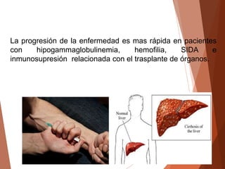 La progresión de la enfermedad es mas rápida en pacientes
con hipogammaglobulinemia, hemofilia, SIDA e
inmunosupresión relacionada con el trasplante de órganos.
 