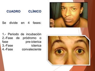 CUADRO CLÍNICO
Se divide en 4 fases:
1.- Periodo de incubación
2.-Fase de pródromo o
fase pre-icterica
3.-Fase icterica
4.-Fase convaleciente
 