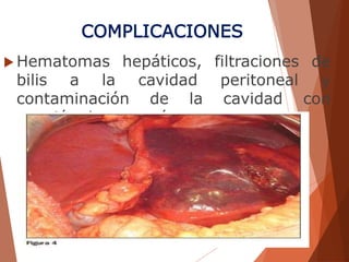 COMPLICACIONES
 Hematomas hepáticos, filtraciones de
bilis a la cavidad peritoneal y
contaminación de la cavidad con
punción de otras vísceras.
 
