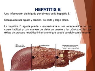 HEPATITIS B
Una inflamación del hígado por el virus de la hepatitis B.
Esta puede ser aguda y crónica, de corto y largo plazo.
La hepatitis B aguda puede ir encaminada a una recuperación con un
curso habitual y con manejo de dieta en cuanto a la crónica en la cual
existe un proceso necrótico inflamatorio que puede concluir con la muerte.
 