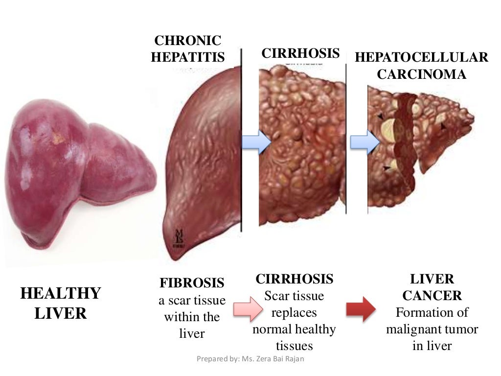 hepatitis-awareness