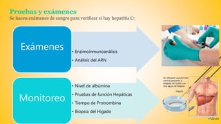 Pruebas y exámenes
Se hacen exámenes de sangre para verificar si hay hepatitis C:
• Enzimoinmunoanálisis
• Análisis del ARN
Exámenes
• Nivel de albúmina
• Pruebas de función Hepáticas
• Tiempo de Protrombina
• Biopsia del Hígado
Monitoreo
 