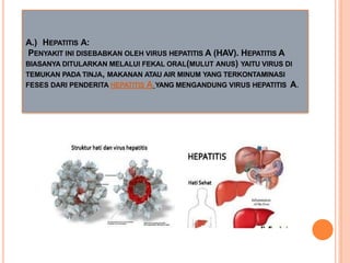 A.) HEPATITIS A:
PENYAKIT INI DISEBABKAN OLEH VIRUS HEPATITIS A (HAV). HEPATITIS A
BIASANYA DITULARKAN MELALUI FEKAL ORAL(MULUT ANUS) YAITU VIRUS DI
TEMUKAN PADA TINJA, MAKANAN ATAU AIR MINUM YANG TERKONTAMINASI
FESES DARI PENDERITA HEPATITIS A YANG MENGANDUNG VIRUS HEPATITIS A.
 