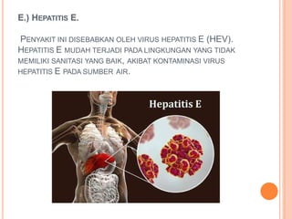E.) HEPATITIS E.
PENYAKIT INI DISEBABKAN OLEH VIRUS HEPATITIS E (HEV).
HEPATITIS E MUDAH TERJADI PADA LINGKUNGAN YANG TIDAK
MEMILIKI SANITASI YANG BAIK, AKIBAT KONTAMINASI VIRUS
HEPATITIS E PADA SUMBER AIR.
 