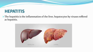 HEPATITIS
The hepatitis is the inflammation of the liver, hepatocytes by viruses reffered
as hepatitis.
 