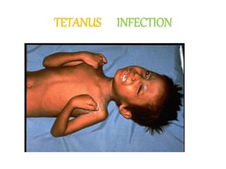 TETANUS INFECTION
 