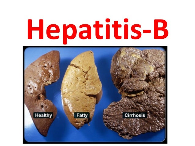 Image result for hepatitis b