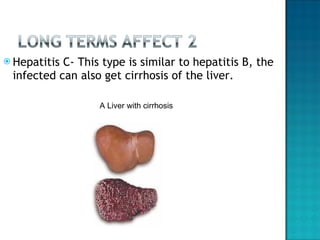 Hepatitis C- This type is similar to hepatitis B, the infected can also get cirrhosis of the liver. A Liver with cirrhosis 