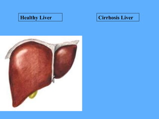 Healthy Liver Cirrhosis Liver
 