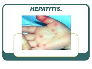 HEPATITIS. 