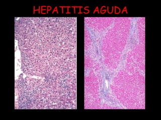 HEPATITIS AGUDA 
 
