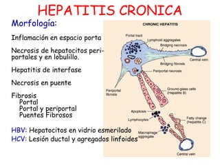 HEPATITIS CRONICA 
Morfología: 
Inflamación en espacio porta 
Necrosis de hepatocitos peri-portales 
y en lobulillo. 
Hepatitis de interfase 
Necrosis en puente 
Fibrosis 
Portal 
Portal y periportal 
Puentes Fibrosos 
HBV: Hepatocitos en vidrio esmerilado 
HCV: Lesión ductal y agregados linfoides 
 