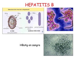 HEPATITIS B 
HBsAg en sangre 
 