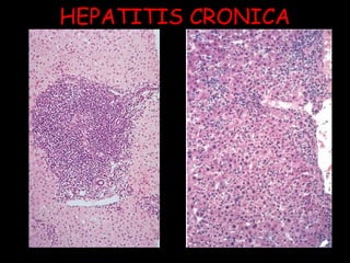 HEPATITIS CRONICA 
 