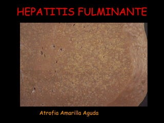 HEPATITIS FULMINANTE 
Atrofia Amarilla Aguda 
 