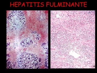 HEPATITIS FULMINANTE 
 