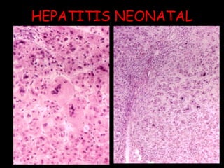 HEPATITIS NEONATAL 
 