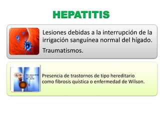 HEPATITIS 
Lesiones debidas a la interrupción de la 
irrigación sanguínea normal del hígado. 
Traumatismos. 
Presencia de trastornos de tipo hereditario 
como fibrosis quística o enfermedad de Wilson. 
 