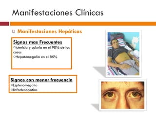 Manifestaciones   Clínicas  Manifestaciones Hepáticas Signos mas Frecuentes Ictericia y coluria en el 90% de los casos Hepatomegalia en el 85% Signos con menor frecuencia Esplenomegalia linfadenopatias 