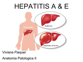 HEPATITIS A & E
Viviana Flaquer
Anatomia Patologica II
 