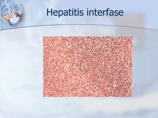 CRITERIO DIAGNOSTICO CODIFICADO DEL GRUPO INTERNACIONAL DE HEPATITIS AUTOINMUNEManns MP, Czaja AJ, Gorham JD, et al. Diagnosis and management of autoimmune hepatitis. Hepatology 2010; 51:2193.