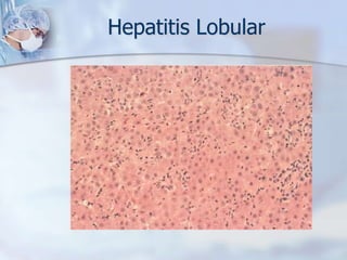 SCORE SIMPLIFICADO PARA EL DIAGNOSTICO DE LA HAI6puntos: diagnóstico probable, 7 o más: diagnóstico definitivoHennes EM et al, AASLD 2005