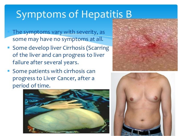 Hepatitis B