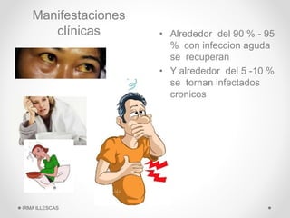 Manifestaciones
clínicas • Alrededor del 90 % - 95
% con infeccion aguda
se recuperan
• Y alrededor del 5 -10 %
se tornan infectados
cronicos
IRMA ILLESCAS
 