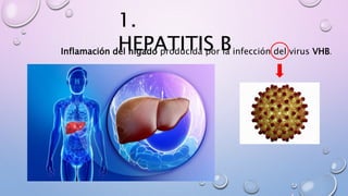 1.
HEPATITIS BInflamación del hígado producida por la infección del virus VHB.
 