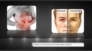 Hepatitis A se caracteriza por inicio súbito, fiebre, escalofríos
 