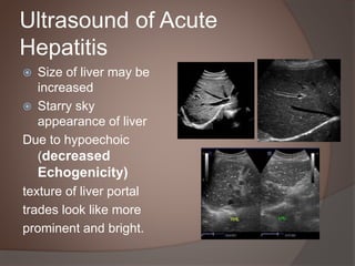 Acute Chronic Hepatitis Sonology Urdu | PPTX
