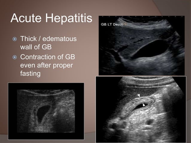 Acute Chronic Hepatitis Sonology Urdu | PPTX
