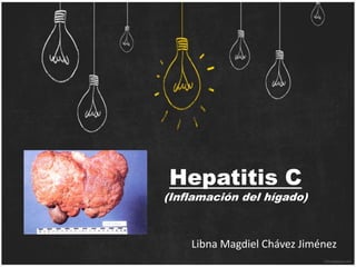 Hepatitis C
(Inflamación del hígado)
Libna Magdiel Chávez Jiménez
 
